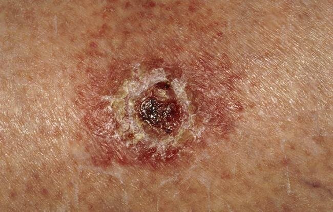 5 Signs Of Skin Cancer Other Than A New Mole