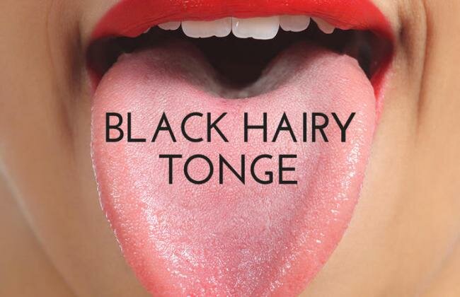 How to Remove Black Spots from Tongue