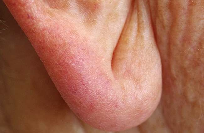 Wrinkled Skin in Front of Ear