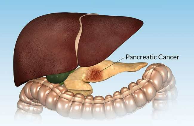 Pancreatic Cancer Vaccine