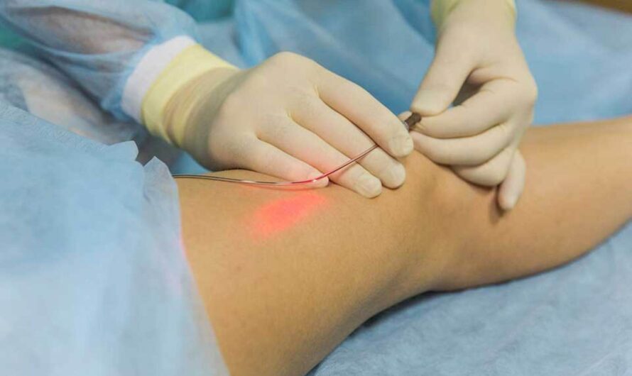 Endovenous Laser Coagulation of Veins in Dubai: A Non-surgical Solution for Varicose Veins